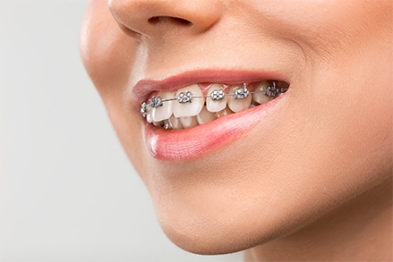 Charming woman smiling with metal braces