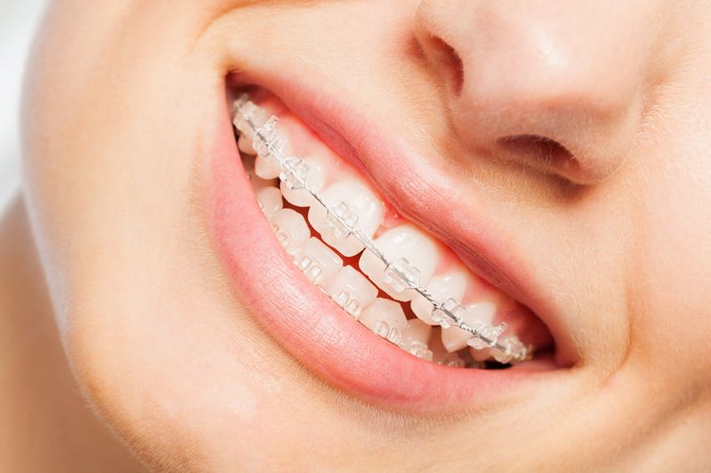 Close-up of woman smiling with clear ceramic braces