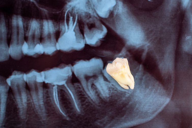 X-ray of impacted wisdom tooth about to grow in