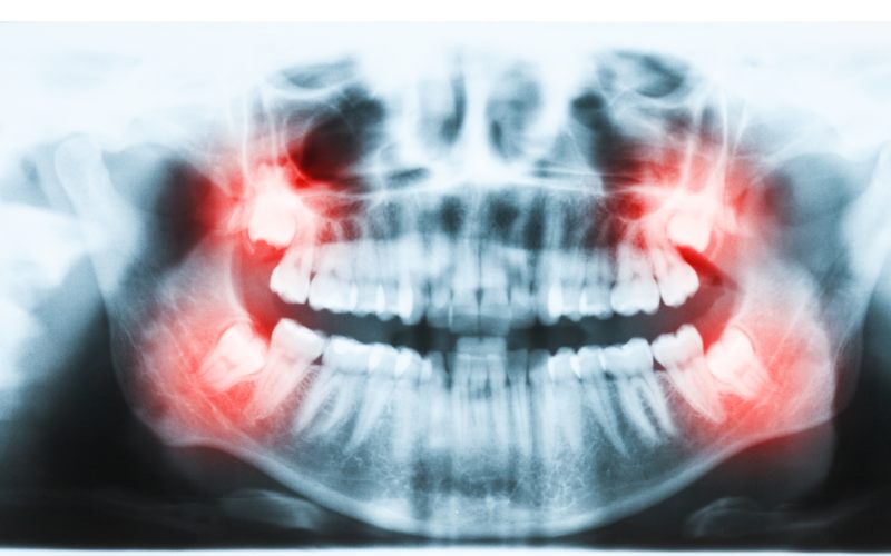 panoramic-x-ray-image of teeth and mouth with all four molars ve