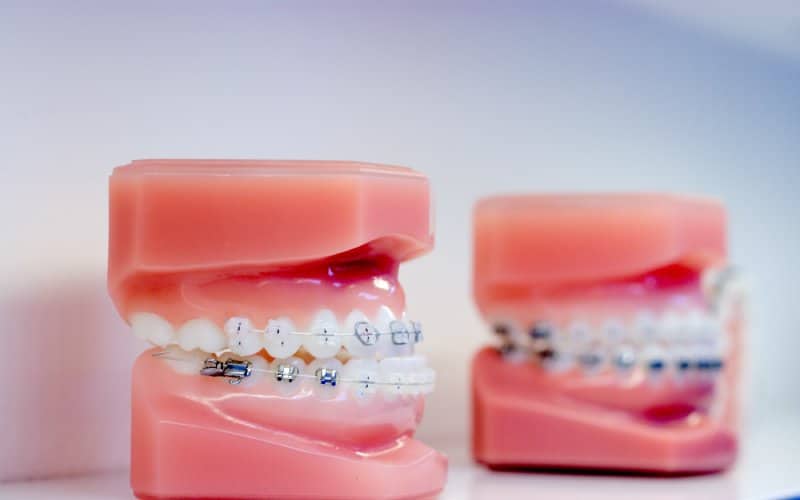 two dental casts braces them white background