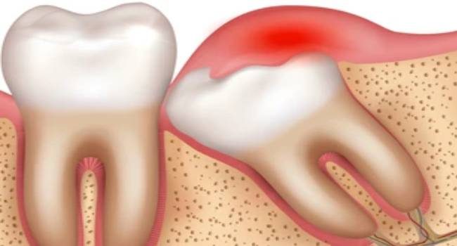 Illustration of sore, impacted wisdom tooth