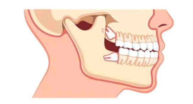 Illustration of human skull with severely impacted wisdom teeth