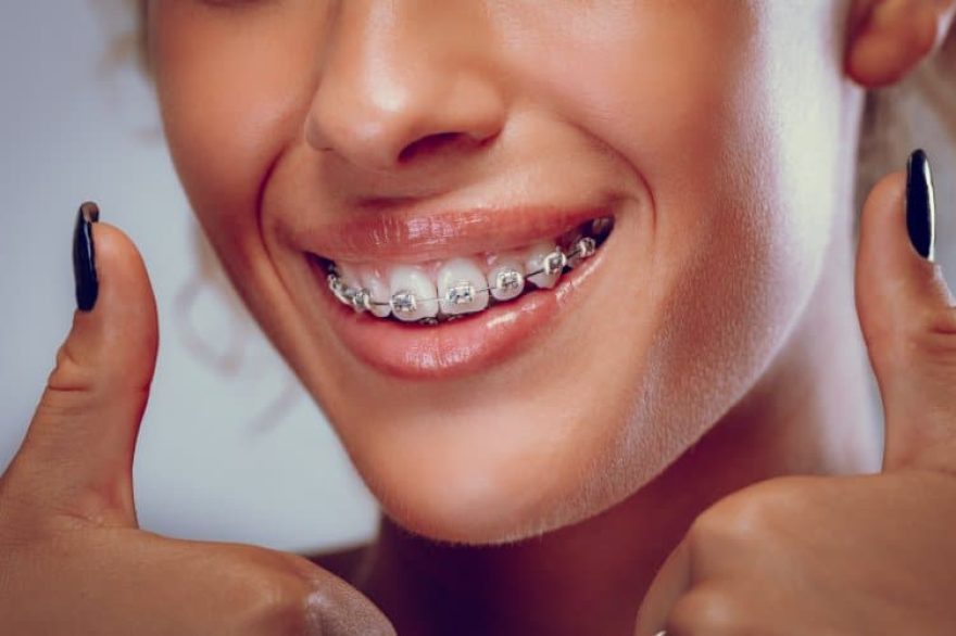 close view smiling woman braces teeth