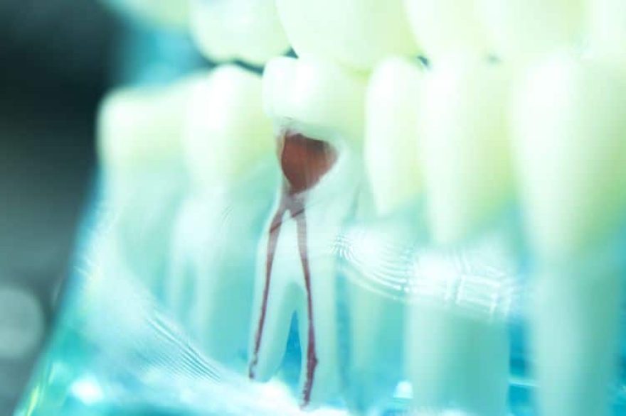 dental tooth root canal dentists teeth