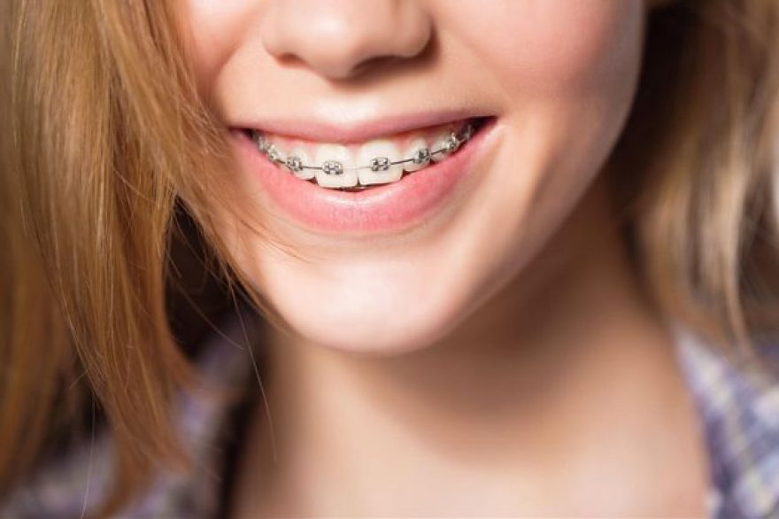 Teen girl smiling with traditional metal braces