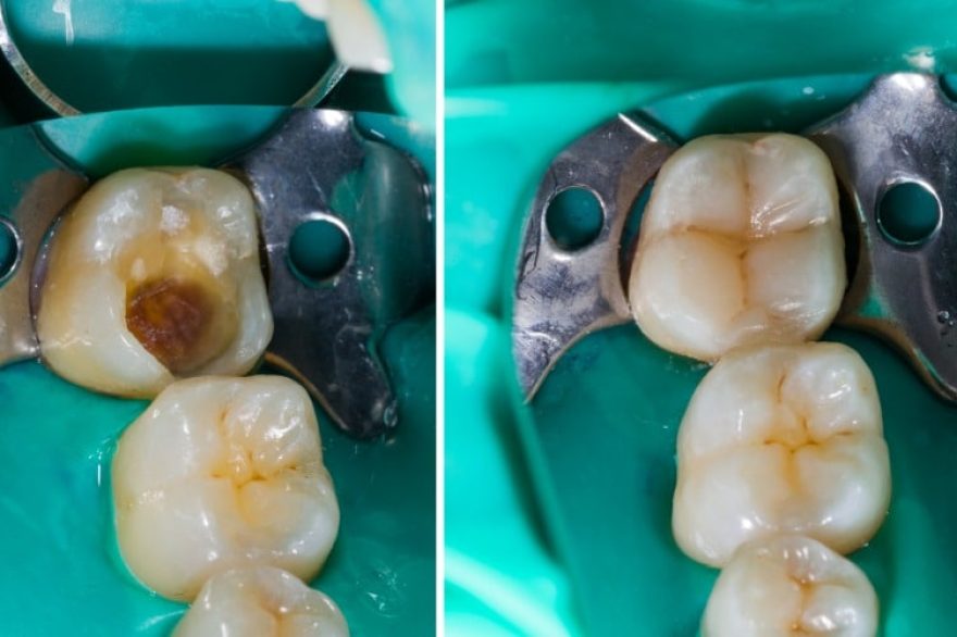 mimicking nature in dentistry