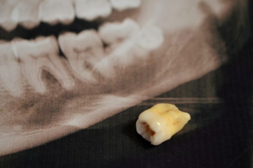 panoramic picture of supercomplete teeth x-ray